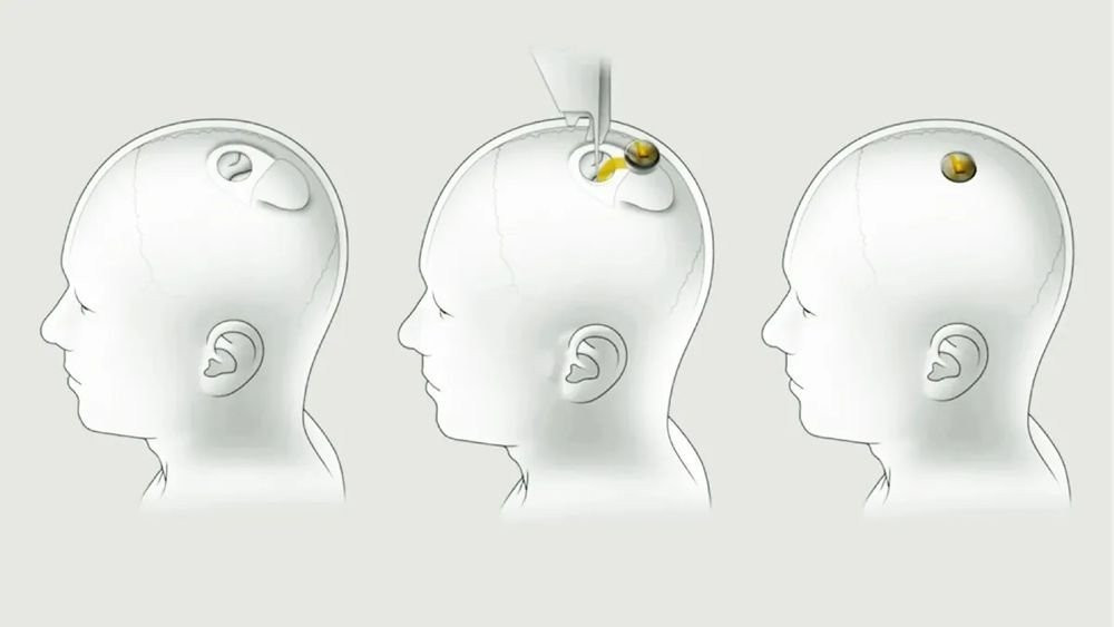 Neuralink: Εμφύτευσε για πρώτη φορά το τσιπ της στον εγκέφαλο ανθρώπου!