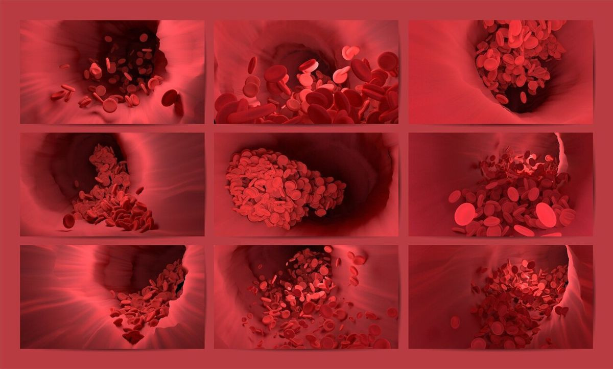 3D εκτυπωμένες αρτηρίες σε chip προβλέπουν τον κίνδυνο εγκεφαλικού
