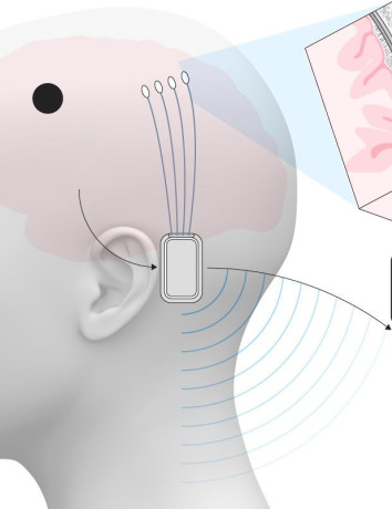 Η Neuralink ξεκινά δοκιμές στον Ηνωμένο Βασίλειο με παραπληγικούς ασθενείς image