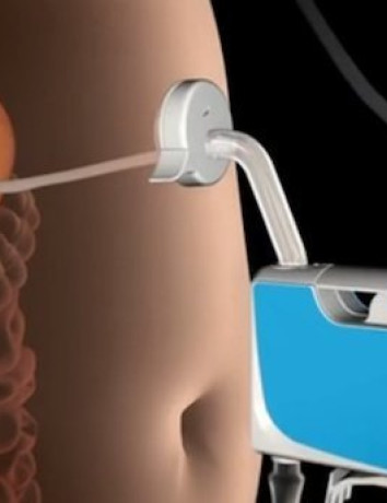 AspireAssist: Νέα μέθοδος αδυνατίσματος αποβάλει το φαγητό από το στομάχι σου! image