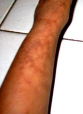 Toasted Skin Syndrome: Η δερματική ασθένεια που προκαλείται από τα laptops! image