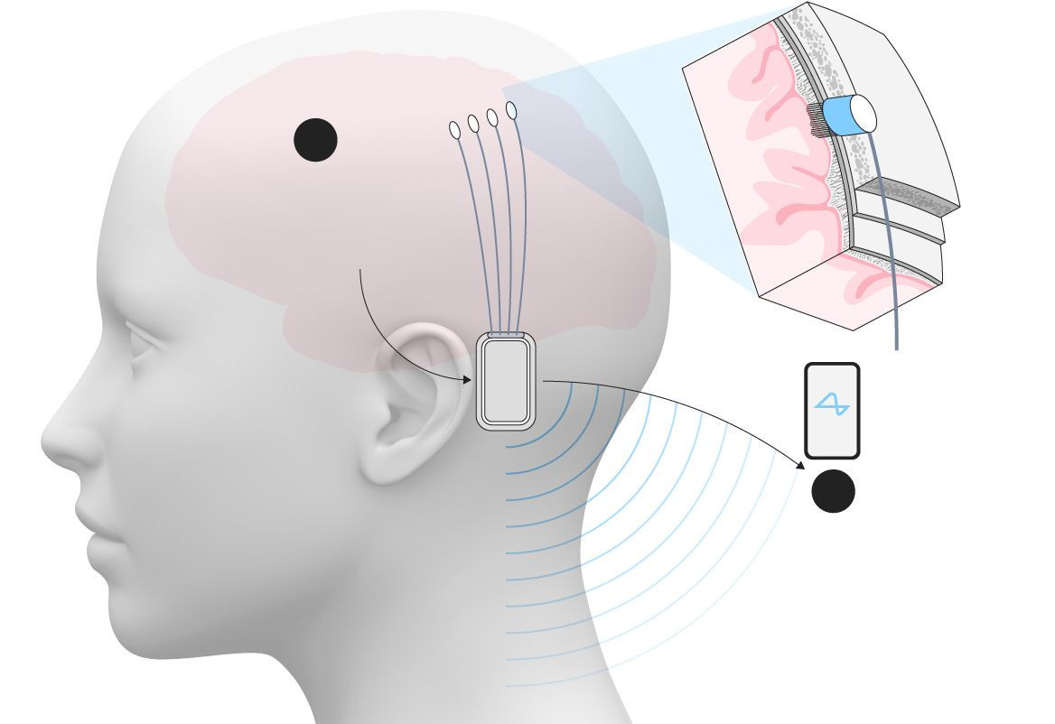 Η Neuralink ξεκινά δοκιμές στον Ηνωμένο Βασίλειο με παραπληγικούς ασθενείς image