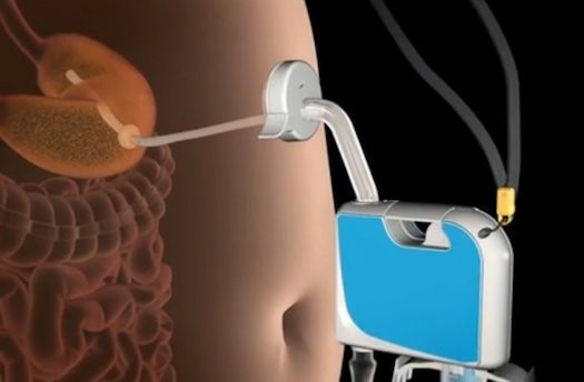 AspireAssist: Νέα μέθοδος αδυνατίσματος αποβάλει το φαγητό από το στομάχι σου! image