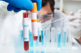 Σύντομα μια απλή αιματολογική εξέταση θα προβλέπει την πορεία της νόσου Alzheimer image