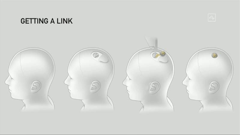 Neuralink: Ο Elon Musk ετοιμάζει τη νέα εποχή με το εμφύτευμα για τον εγκέφαλο | 